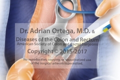 Colon-Rectum_Surgical_Images-8