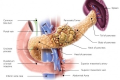Pancreatic Cancer Anatomy