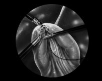 Stomach_Surgery#6-Suturing